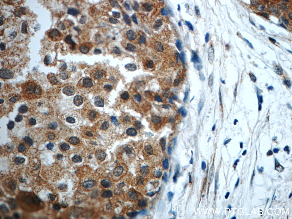 Immunohistochemistry (IHC) staining of human breast cancer tissue using STAT3 Polyclonal antibody (10253-2-AP)
