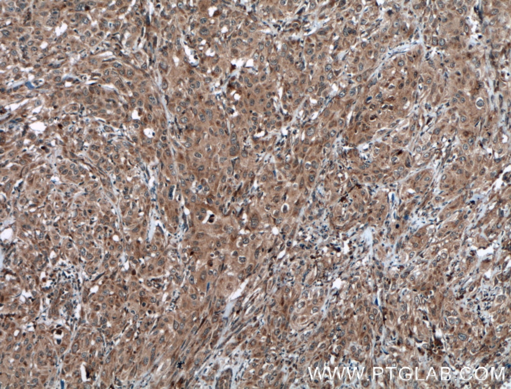 Immunohistochemistry (IHC) staining of human cervical cancer tissue using STAT3 Polyclonal antibody (51076-2-AP)