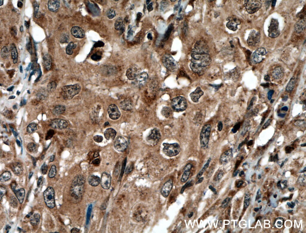 Immunohistochemistry (IHC) staining of human cervical cancer tissue using STAT3 Polyclonal antibody (51076-2-AP)