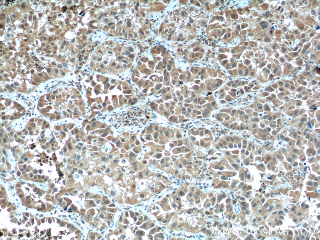 IHC staining of human lung cancer using 51076-2-AP