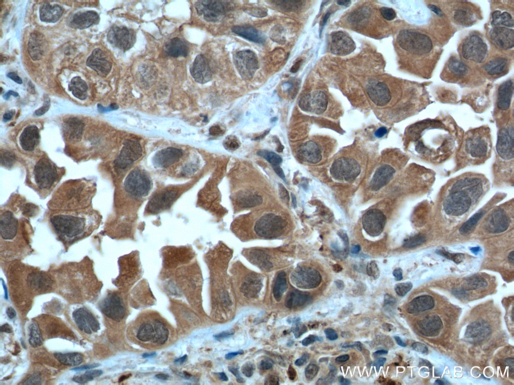 IHC staining of human lung cancer using 51076-2-AP