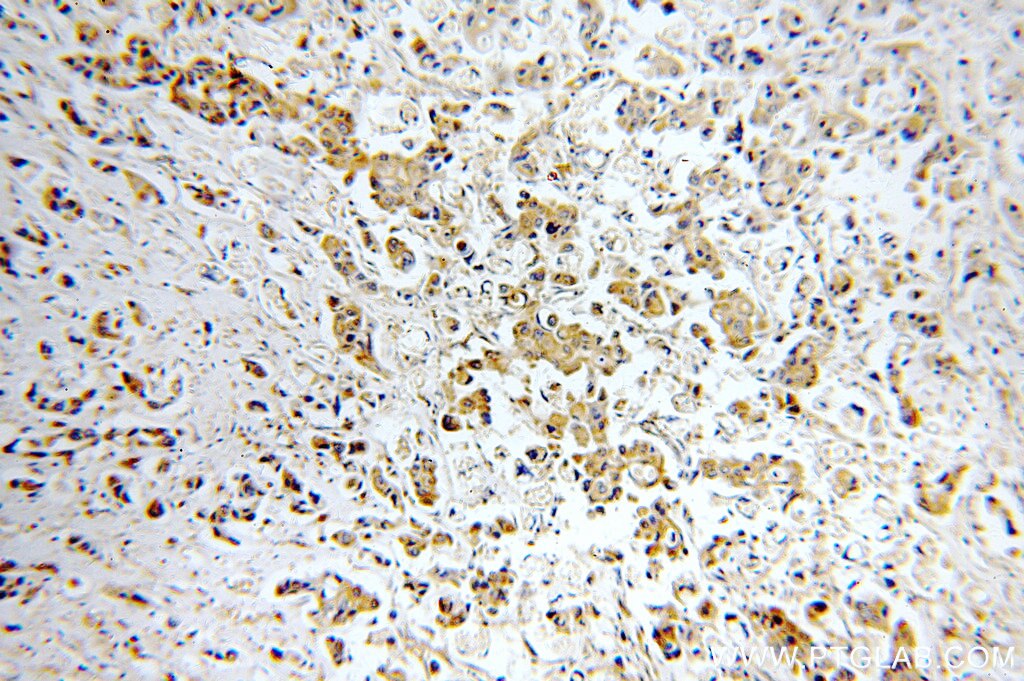 Immunohistochemistry (IHC) staining of human breast cancer tissue using STAT3 Polyclonal antibody (51076-2-AP)