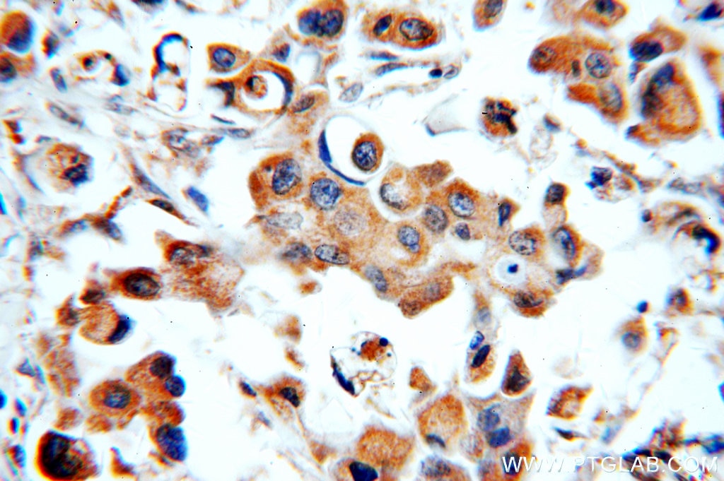 Immunohistochemistry (IHC) staining of human breast cancer tissue using STAT3 Polyclonal antibody (51076-2-AP)