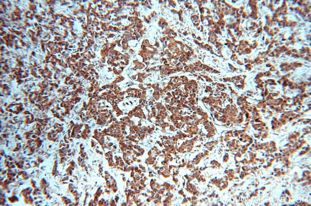 Immunohistochemistry (IHC) staining of human breast cancer tissue using STAT3 Polyclonal antibody (51076-2-AP)