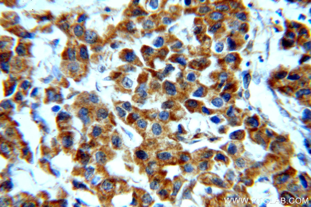 Immunohistochemistry (IHC) staining of human breast cancer tissue using STAT3 Polyclonal antibody (51076-2-AP)