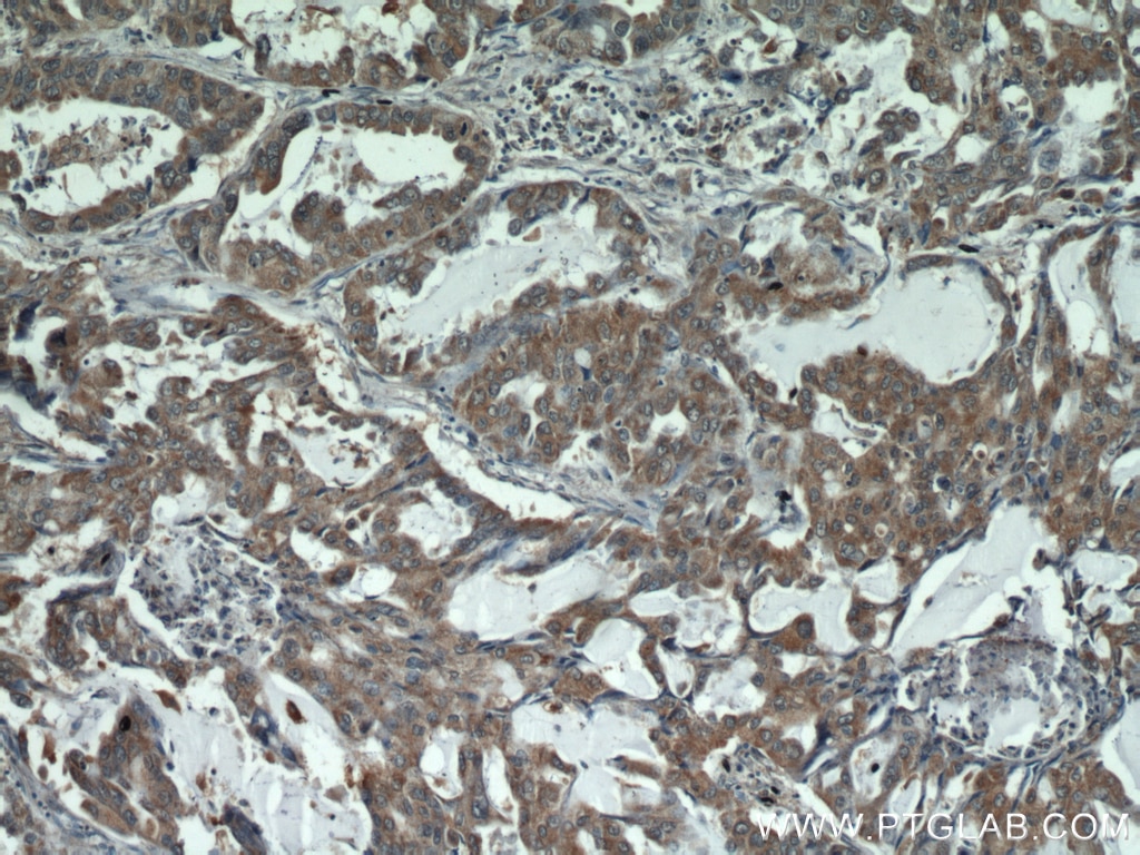 Immunohistochemistry (IHC) staining of human lung cancer tissue using STAT3 Polyclonal antibody (51076-2-AP)