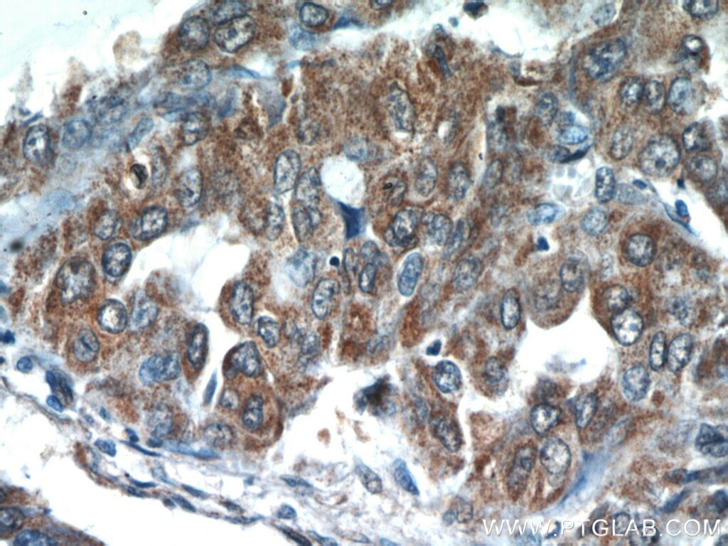 Immunohistochemistry (IHC) staining of human lung cancer tissue using STAT3 Polyclonal antibody (51076-2-AP)