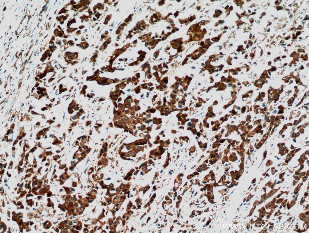 Immunohistochemistry (IHC) staining of human breast cancer tissue using STAT3 Polyclonal antibody (51076-2-AP)