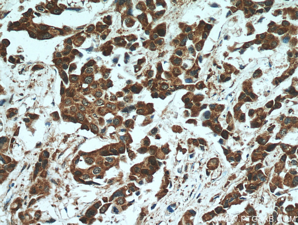 Immunohistochemistry (IHC) staining of human breast cancer tissue using STAT3 Polyclonal antibody (51076-2-AP)