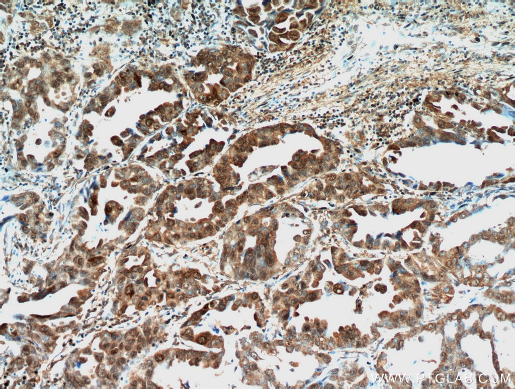 Immunohistochemistry (IHC) staining of human lung cancer tissue using STAT3 Polyclonal antibody (51076-2-AP)