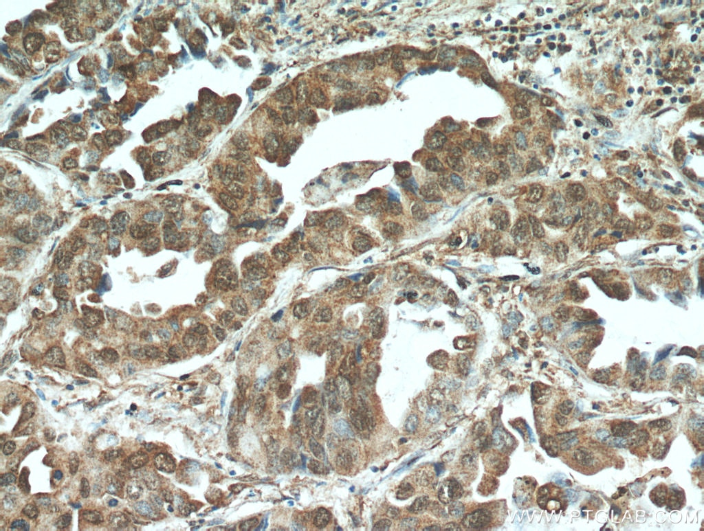 Immunohistochemistry (IHC) staining of human lung cancer tissue using STAT3 Polyclonal antibody (51076-2-AP)