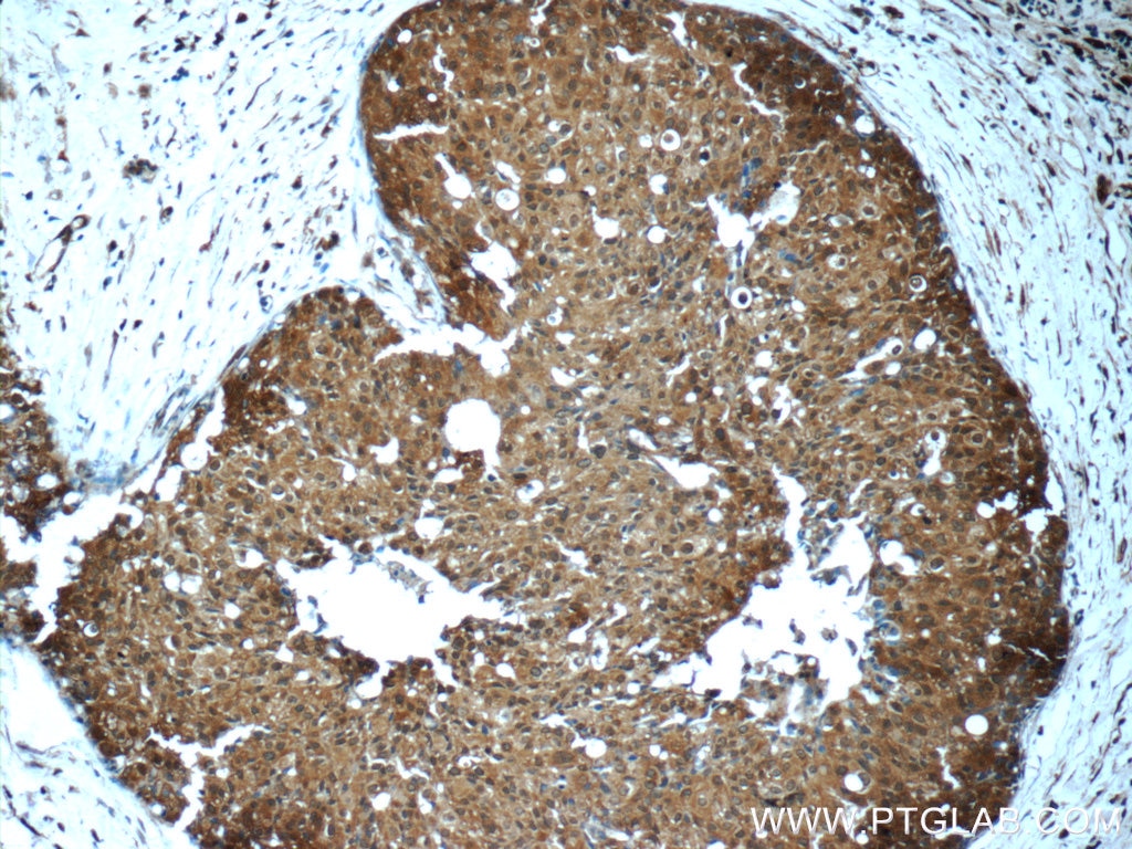 Immunohistochemistry (IHC) staining of human breast cancer tissue using STAT3 Monoclonal antibody (60199-1-Ig)