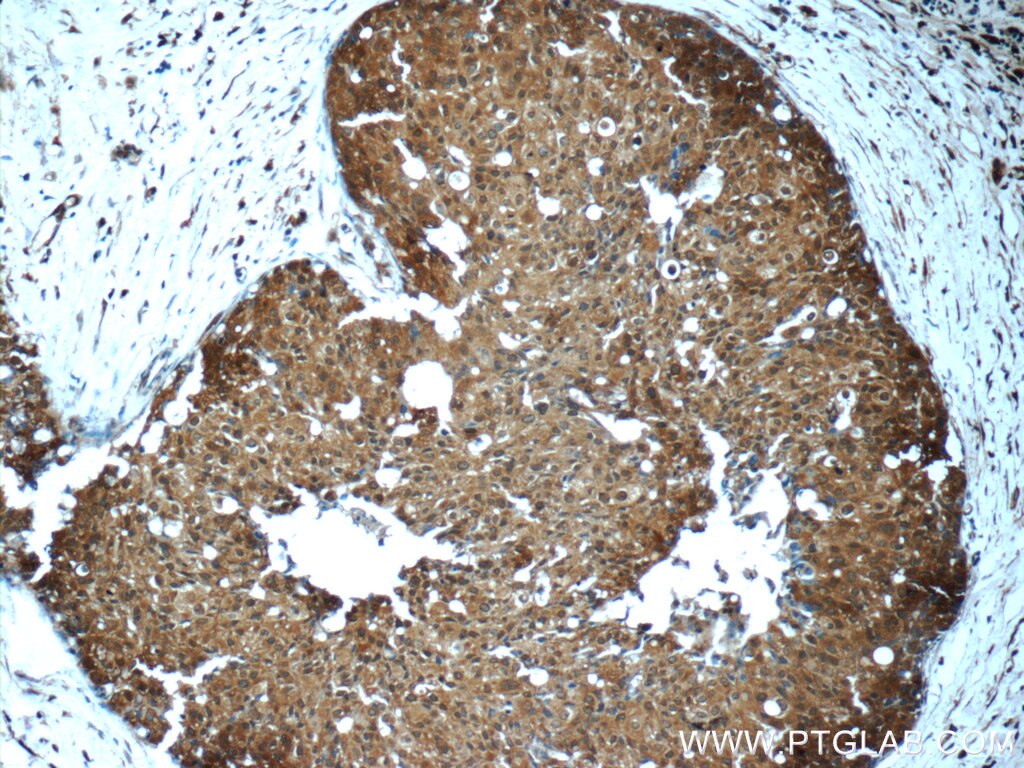 IHC staining of human breast cancer using 60199-1-Ig