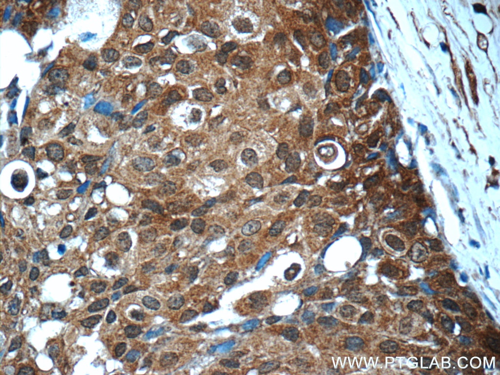 Immunohistochemistry (IHC) staining of human breast cancer tissue using STAT3 Monoclonal antibody (60199-1-Ig)