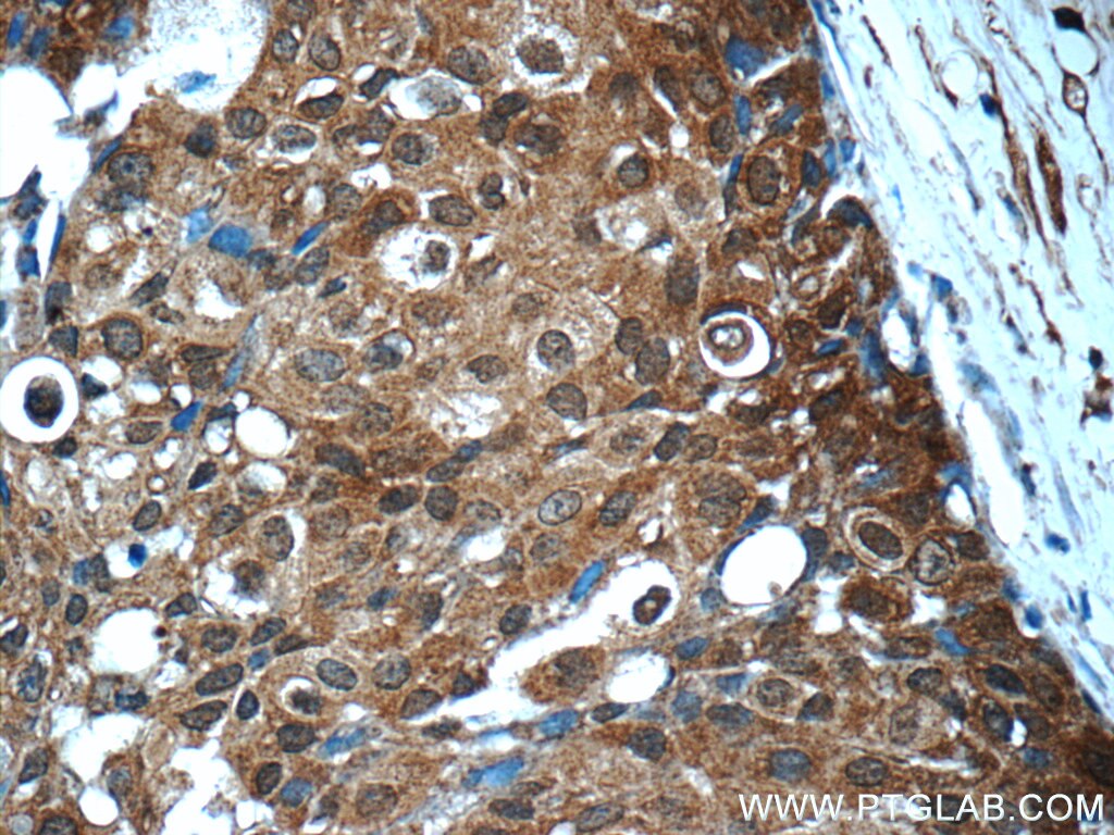 IHC staining of human breast cancer using 60199-1-Ig