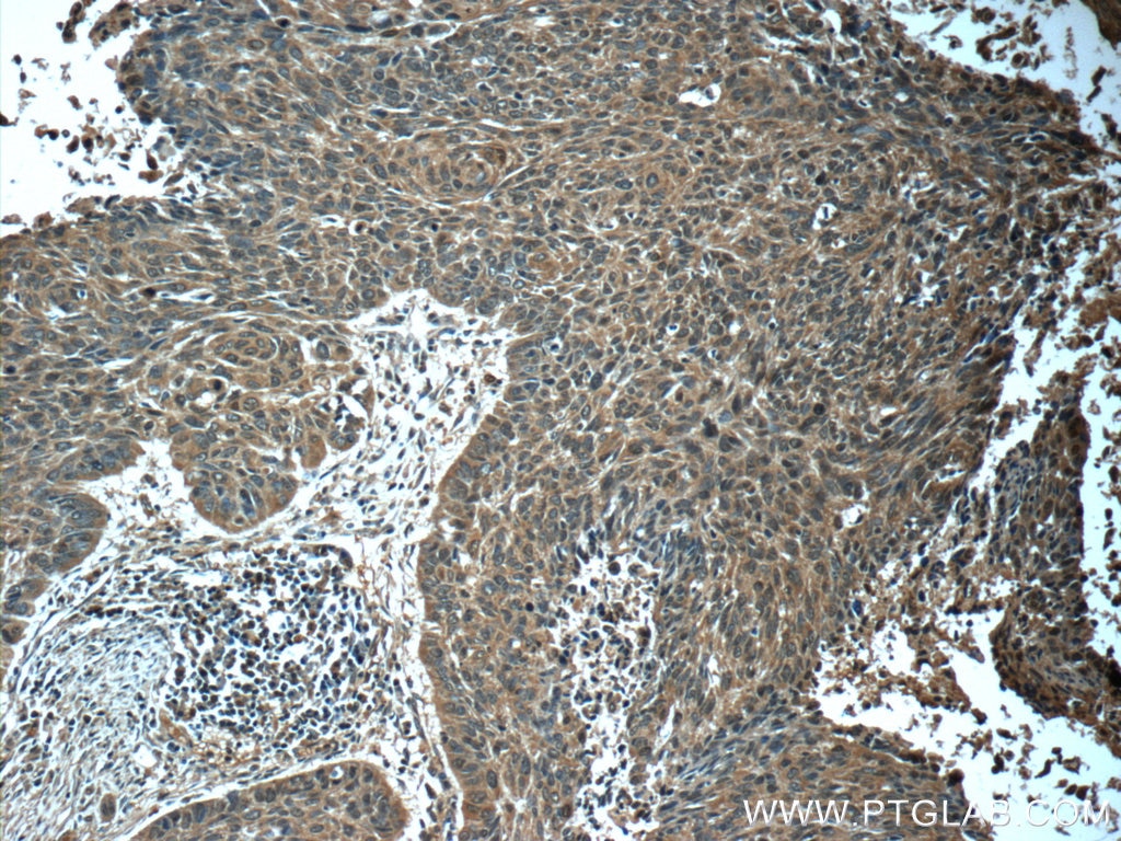 IHC staining of human lung cancer using 60199-1-Ig