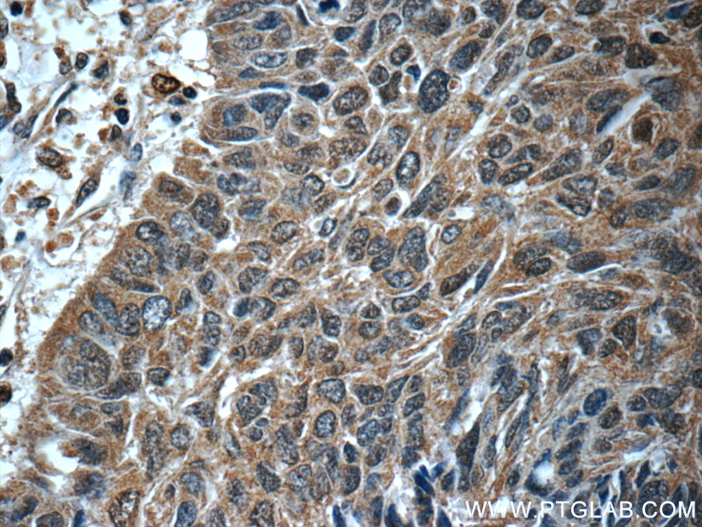 Immunohistochemistry (IHC) staining of human lung cancer tissue using STAT3 Monoclonal antibody (60199-1-Ig)