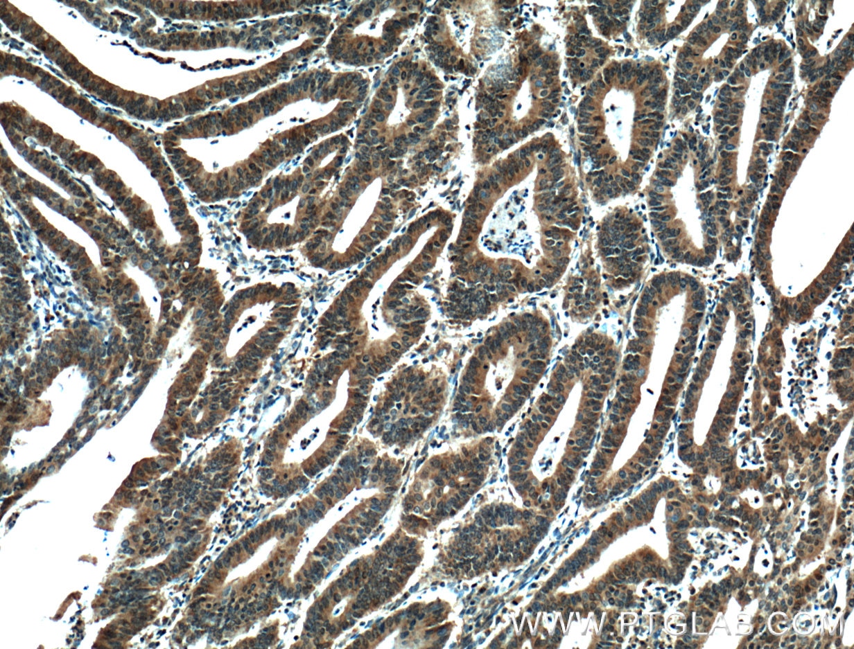 Immunohistochemistry (IHC) staining of human endometrial cancer tissue using STAT3 Monoclonal antibody (60199-1-Ig)