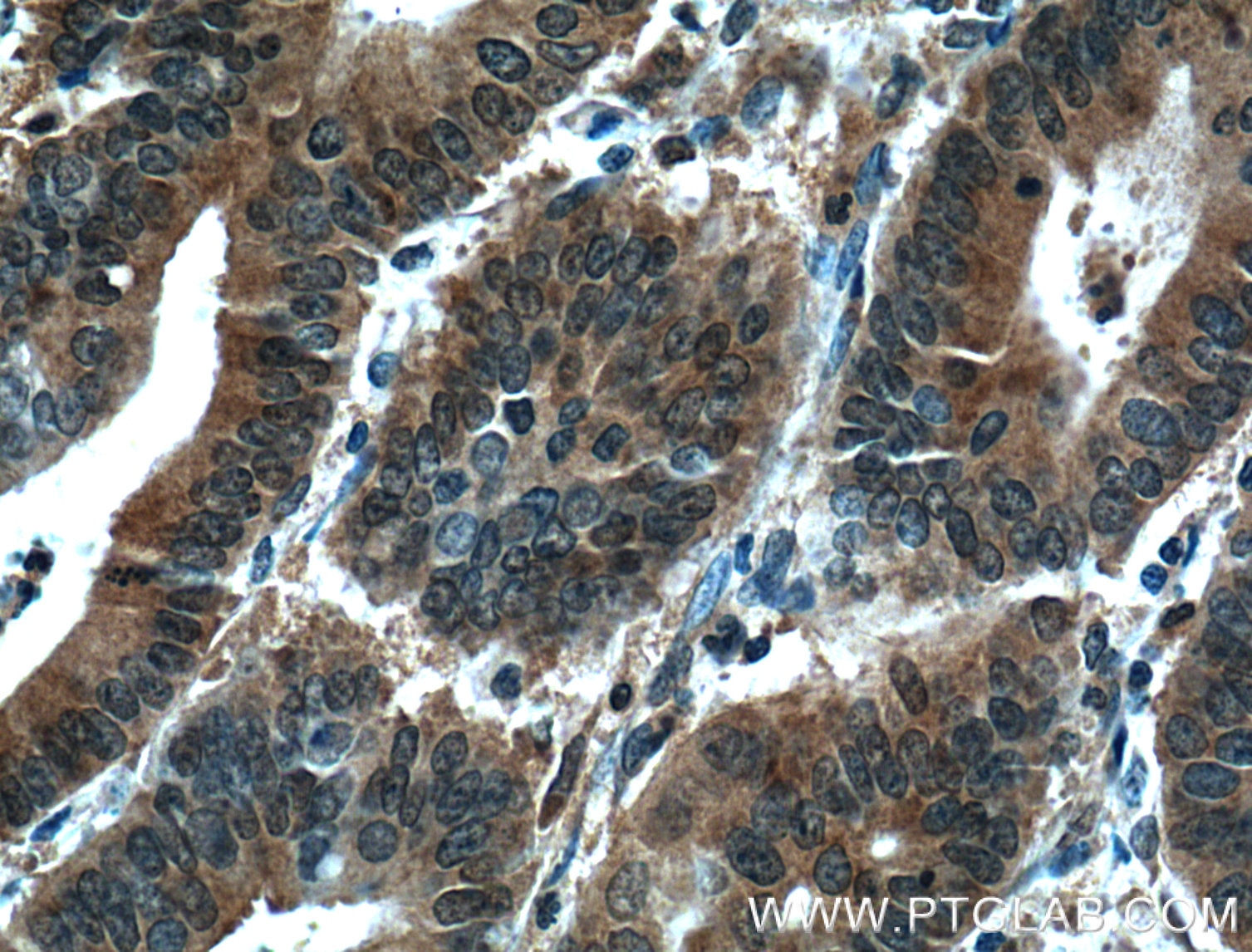 Immunohistochemistry (IHC) staining of human endometrial cancer tissue using STAT3 Monoclonal antibody (60199-1-Ig)