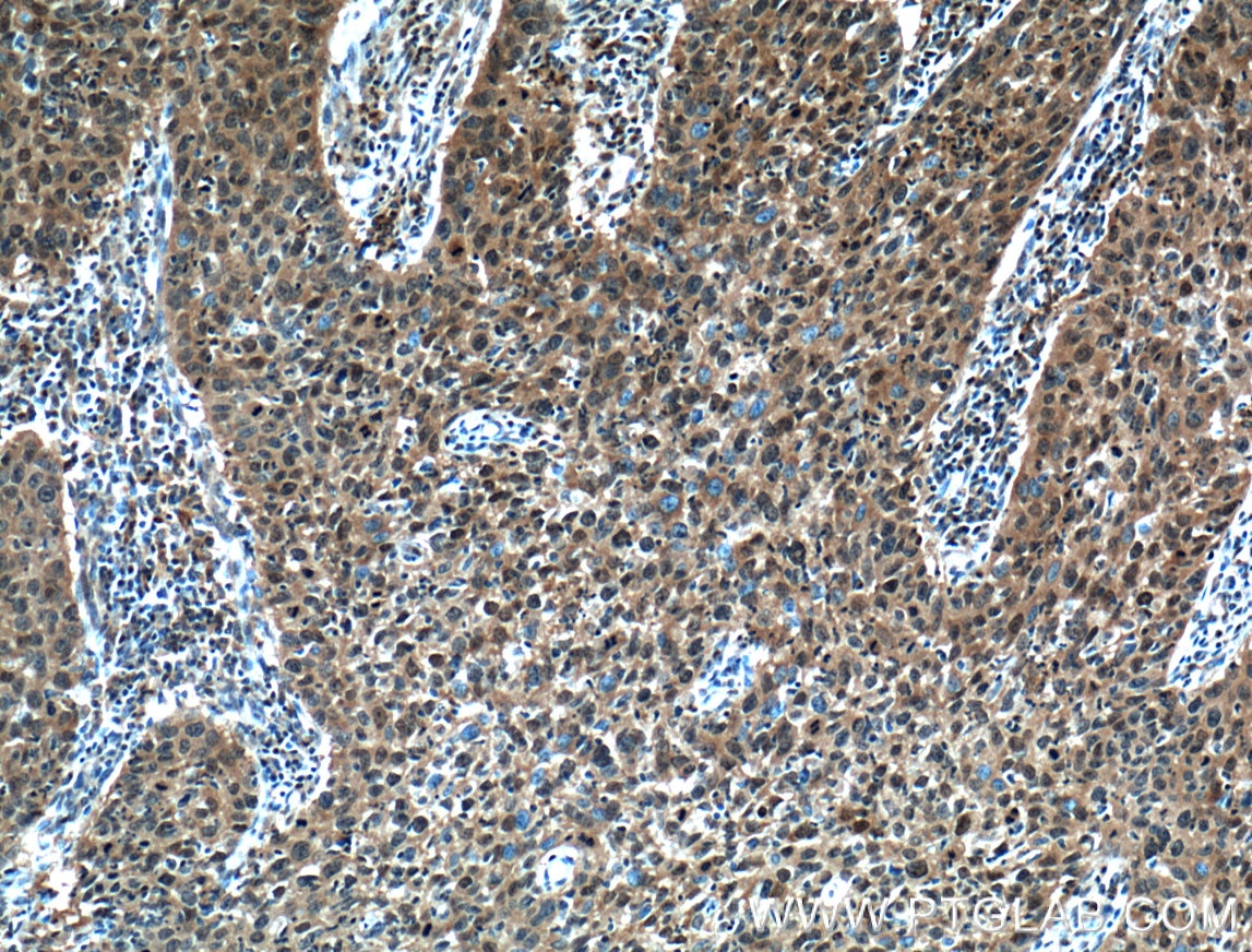 Immunohistochemistry (IHC) staining of human cervical cancer tissue using STAT3 Monoclonal antibody (60199-1-Ig)