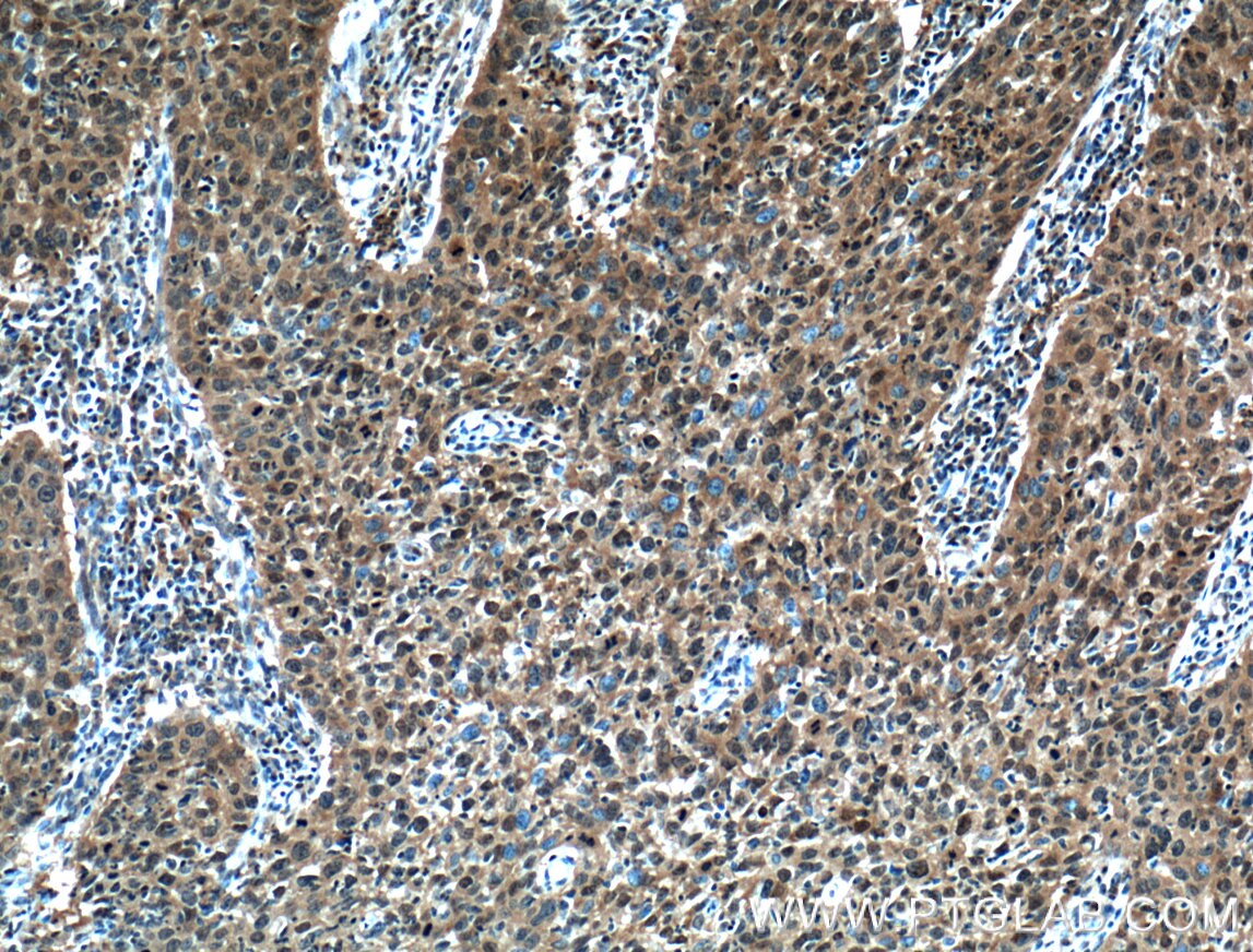 IHC staining of human cervical cancer using 60199-1-Ig