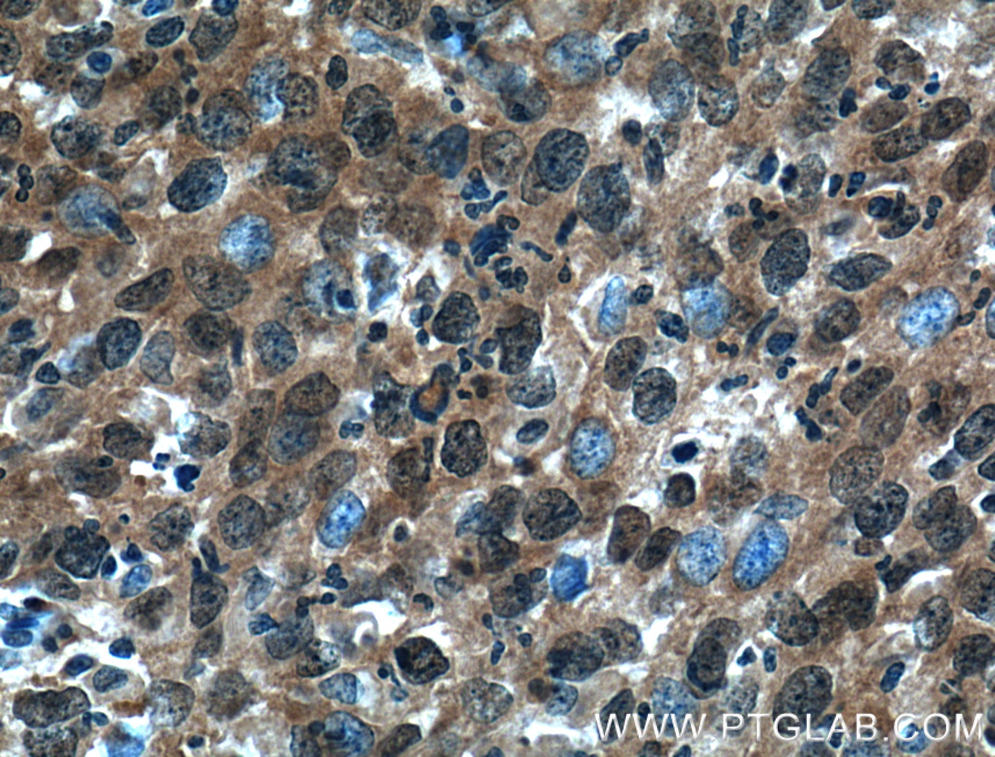 IHC staining of human cervical cancer using 60199-1-Ig