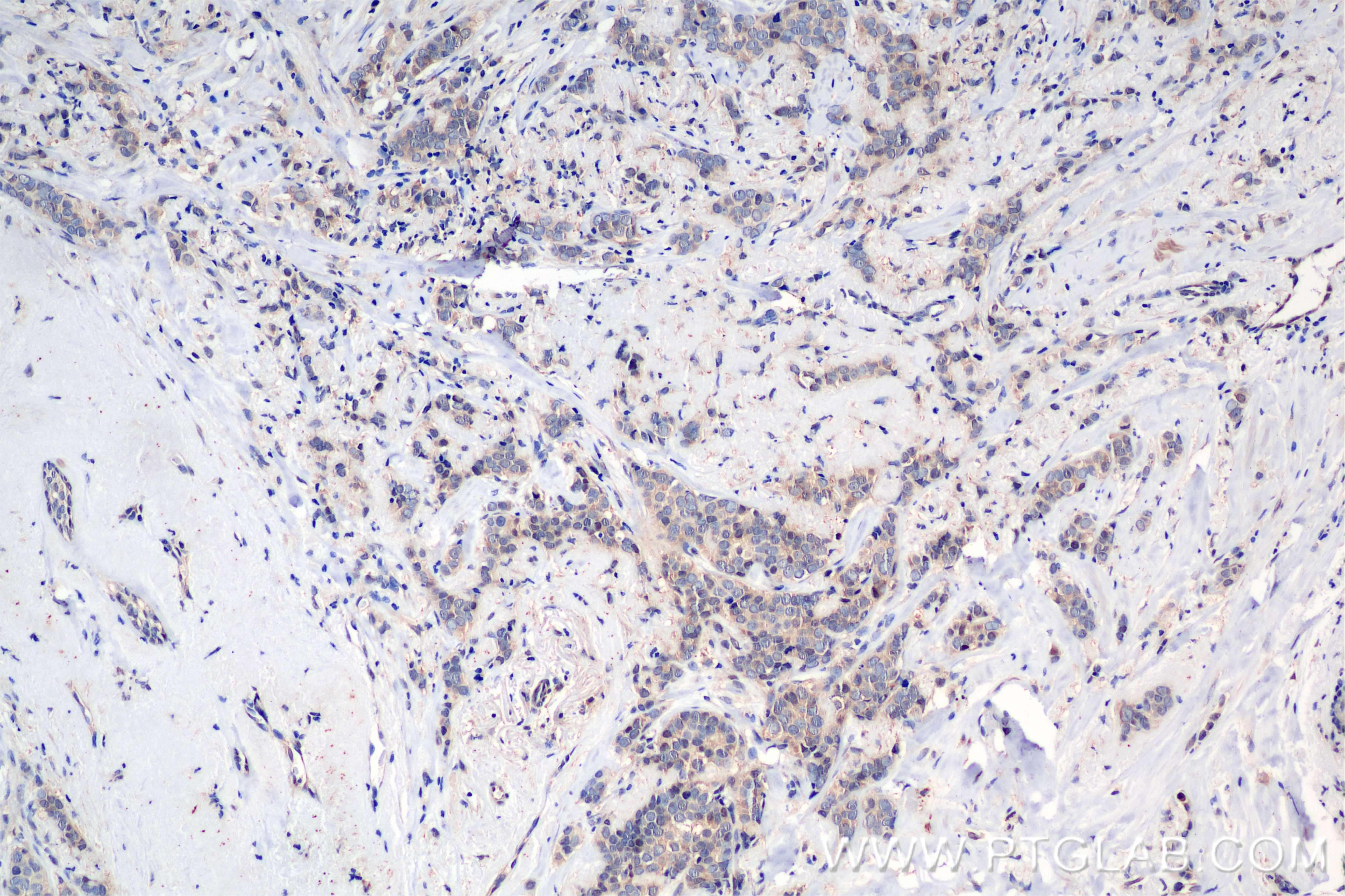 Immunohistochemistry (IHC) staining of human breast cancer tissue using STAT3 Recombinant antibody (80149-1-RR)