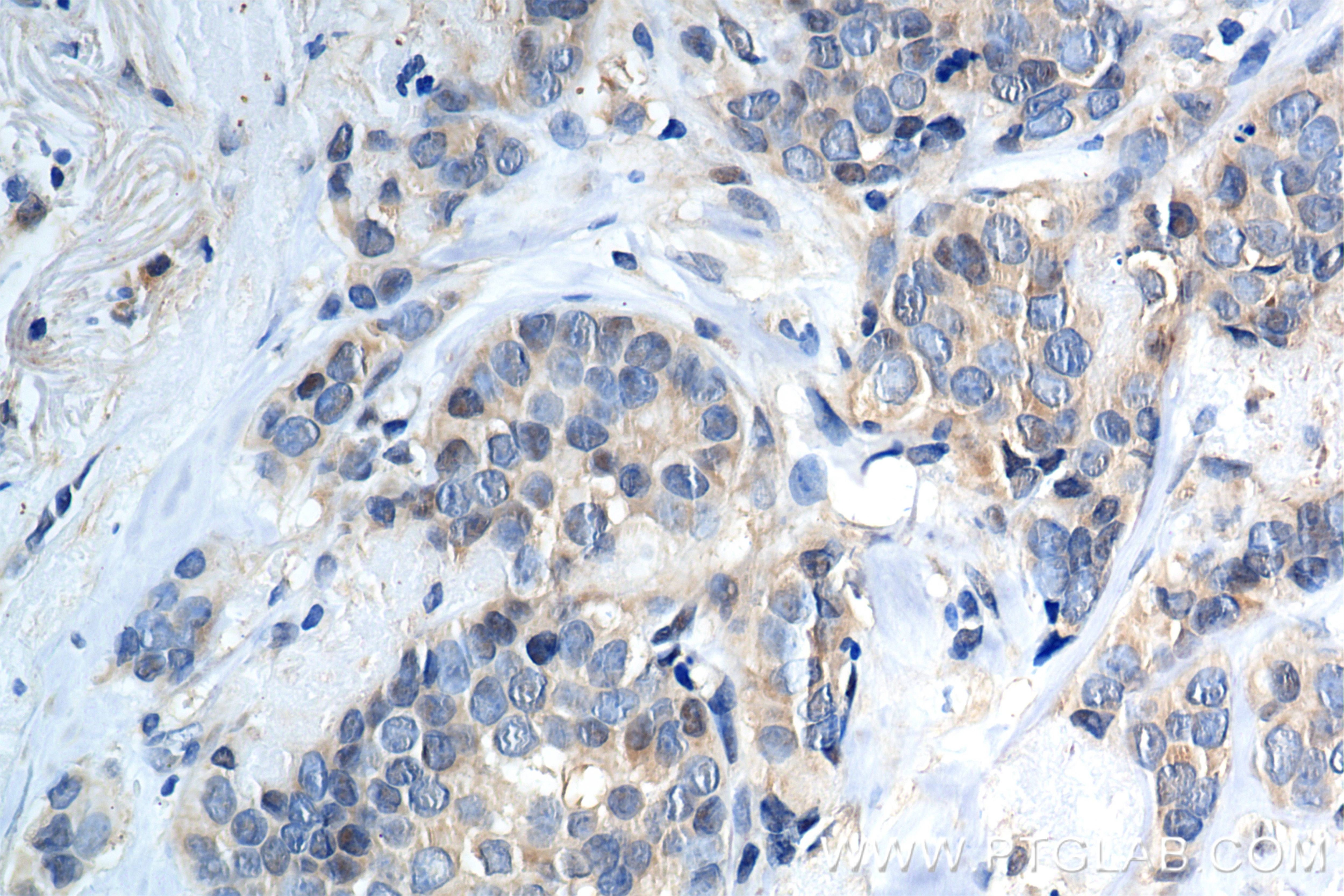 Immunohistochemistry (IHC) staining of human breast cancer tissue using STAT3 Recombinant antibody (80149-1-RR)