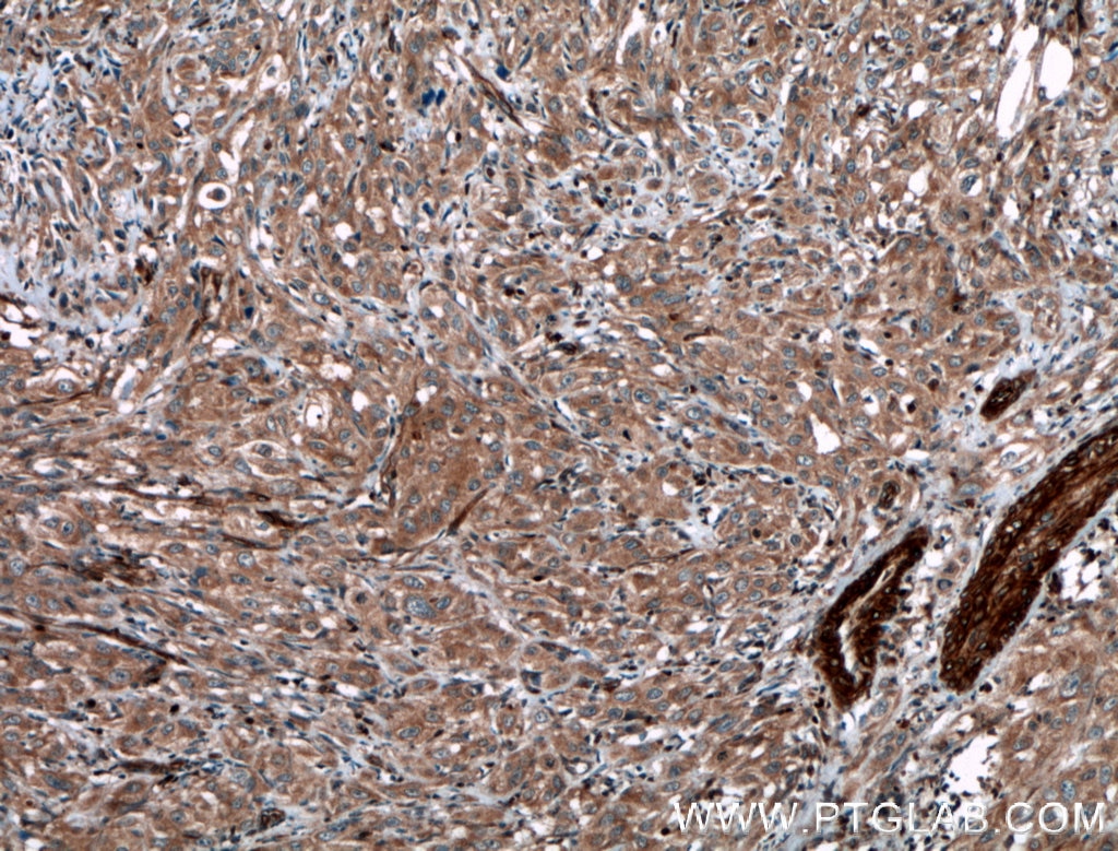 IHC staining of human cervical cancer using 51070-2-AP