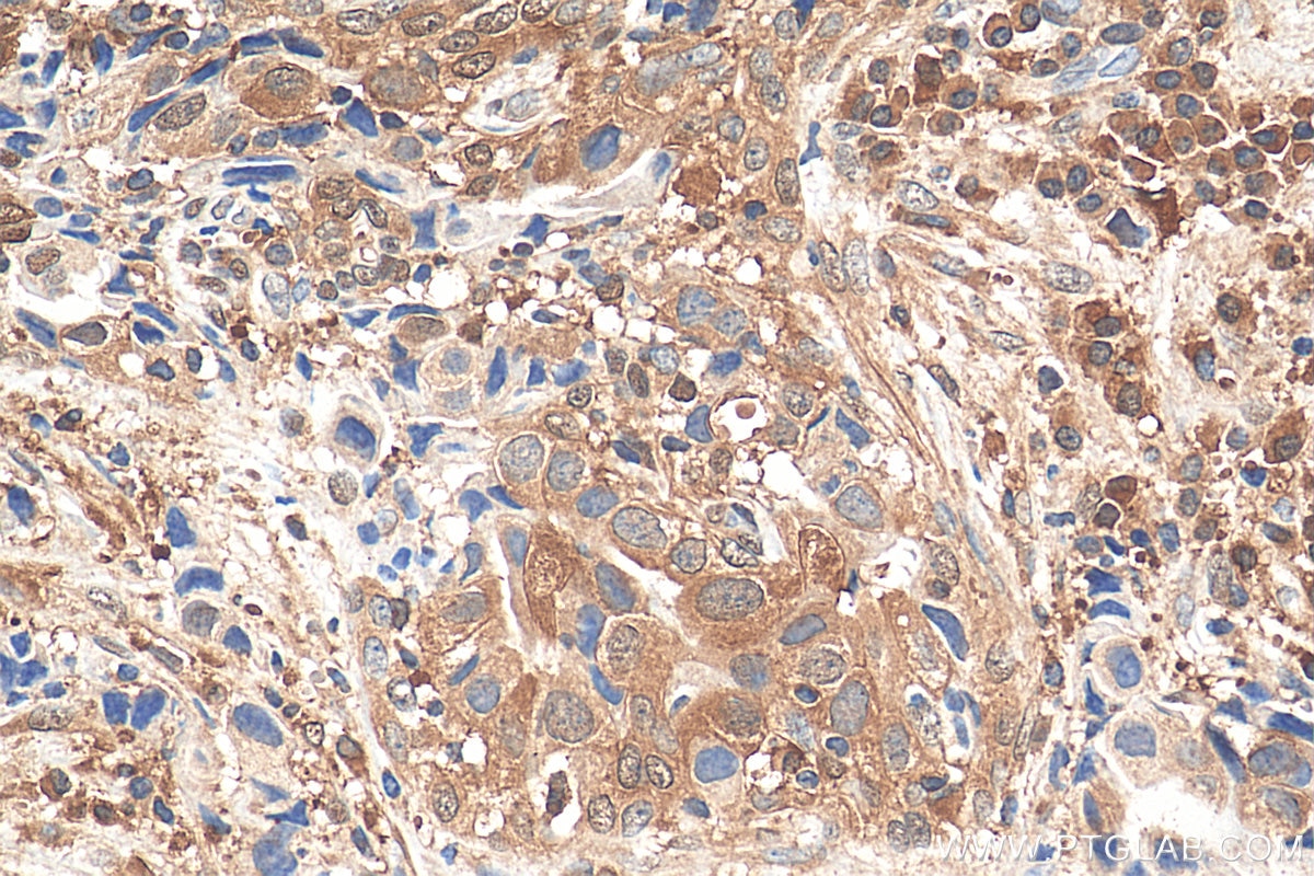 Immunohistochemistry (IHC) staining of human breast cancer tissue using STAT4 Monoclonal antibody (67568-2-Ig)