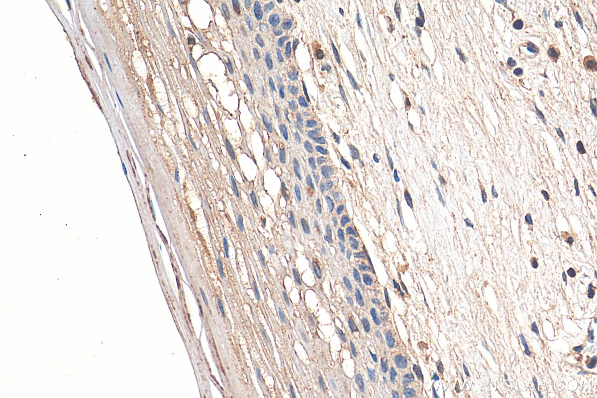 Immunohistochemistry (IHC) staining of human cervical cancer tissue using STAT4 Monoclonal antibody (67568-2-Ig)