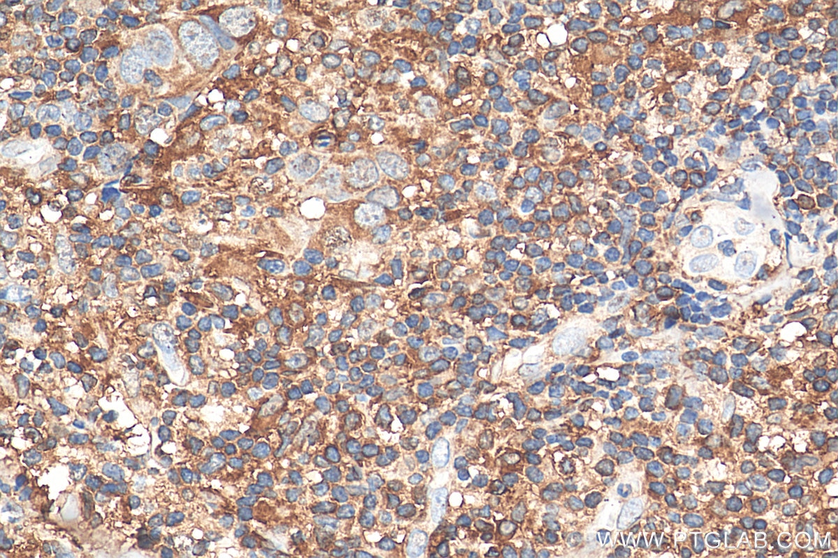 Immunohistochemistry (IHC) staining of human breast cancer tissue using STAT4 Monoclonal antibody (67568-2-Ig)