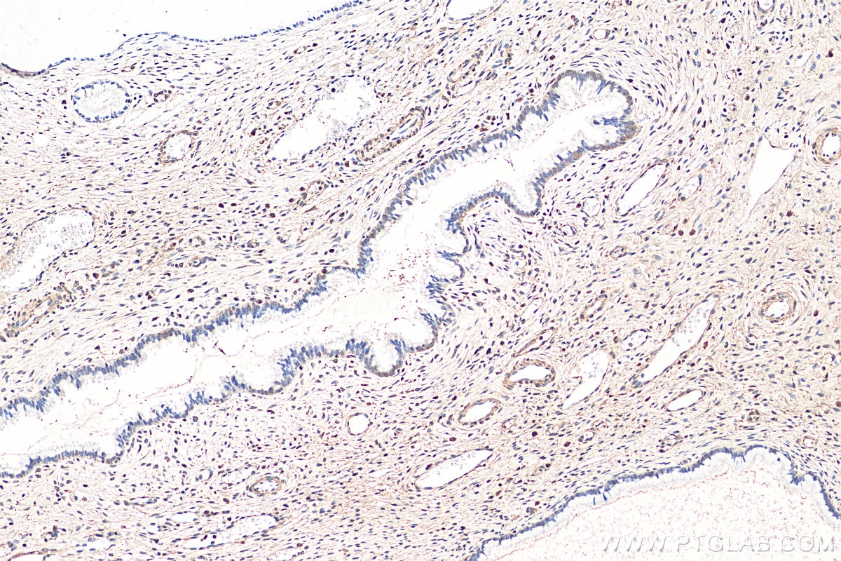 Immunohistochemistry (IHC) staining of human cervical cancer tissue using STAT4 Monoclonal antibody (67568-2-Ig)