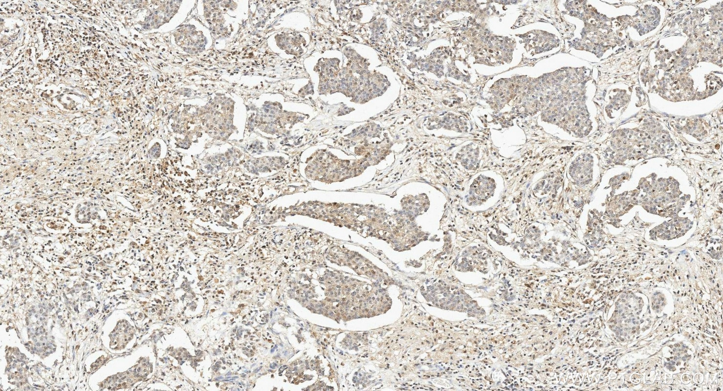 IHC staining of human breast cancer using 67568-2-Ig Immunohistochemistry (IHC) staining of human breast cancer tissue using STAT4 Monoclonal antibody (67568-2-Ig)