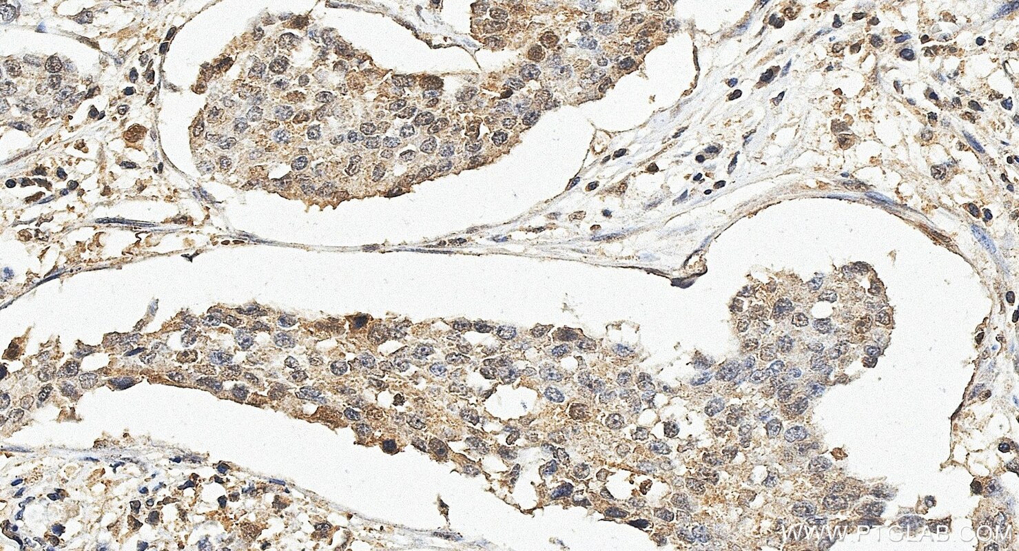 IHC staining of human breast cancer using 67568-2-Ig Immunohistochemistry (IHC) staining of human breast cancer tissue using STAT4 Monoclonal antibody (67568-2-Ig)