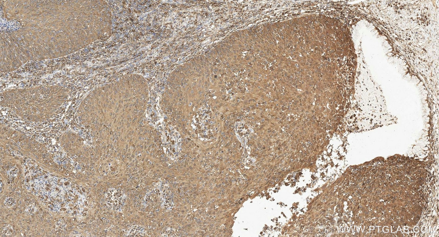 IHC staining of human cervical cancer using 67568-2-Ig Immunohistochemistry (IHC) staining of human cervical cancer tissue using STAT4 Monoclonal antibody (67568-2-Ig)
