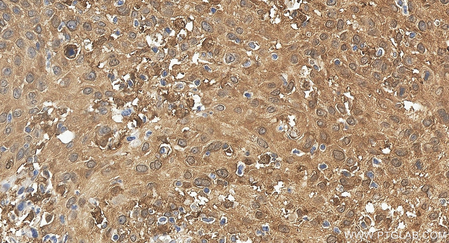 IHC staining of human cervical cancer using 67568-2-Ig Immunohistochemistry (IHC) staining of human cervical cancer tissue using STAT4 Monoclonal antibody (67568-2-Ig)