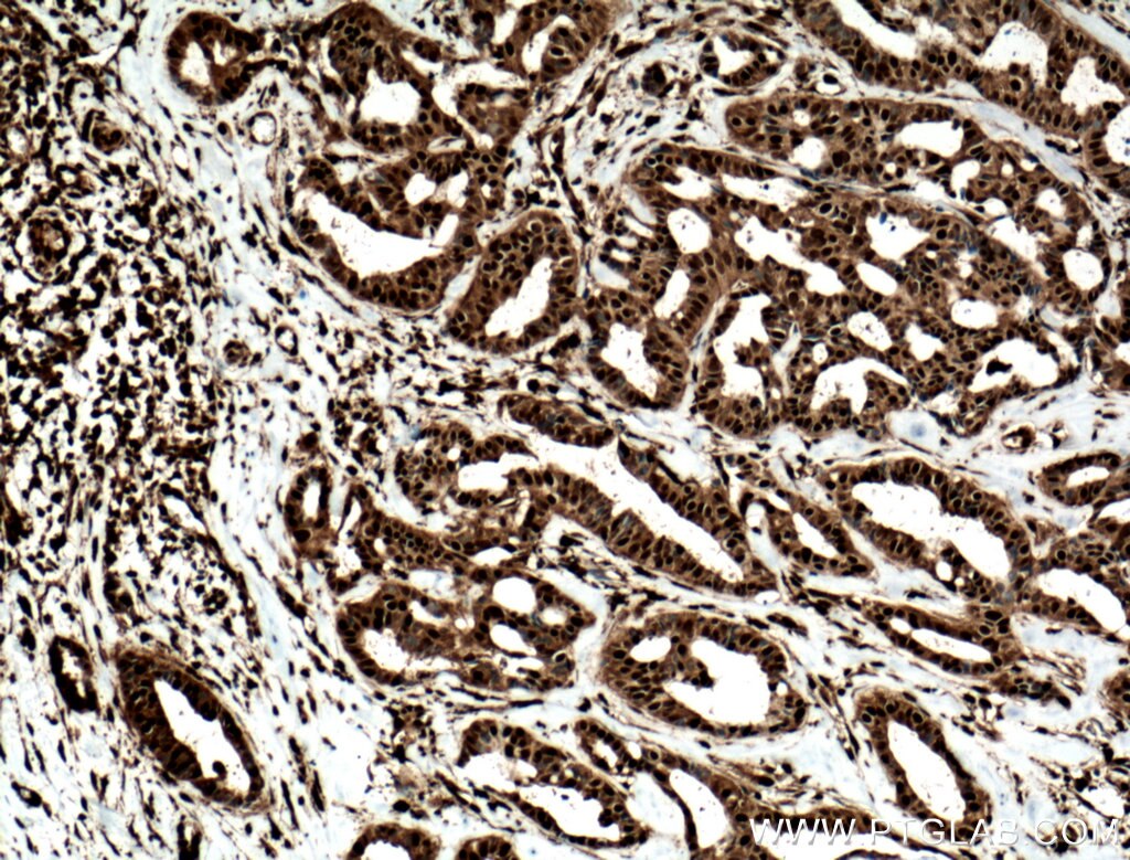 Immunohistochemistry (IHC) staining of human breast cancer tissue using STAT5A/B Polyclonal antibody (13179-1-AP)