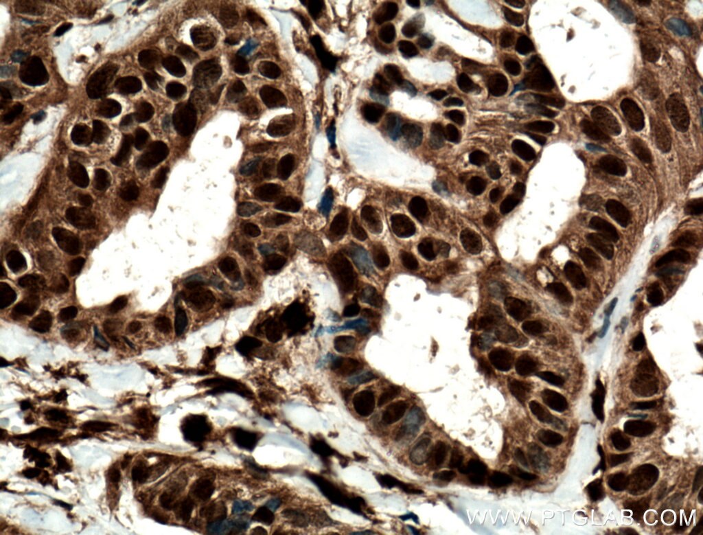 Immunohistochemistry (IHC) staining of human breast cancer tissue using STAT5A/B Polyclonal antibody (13179-1-AP)