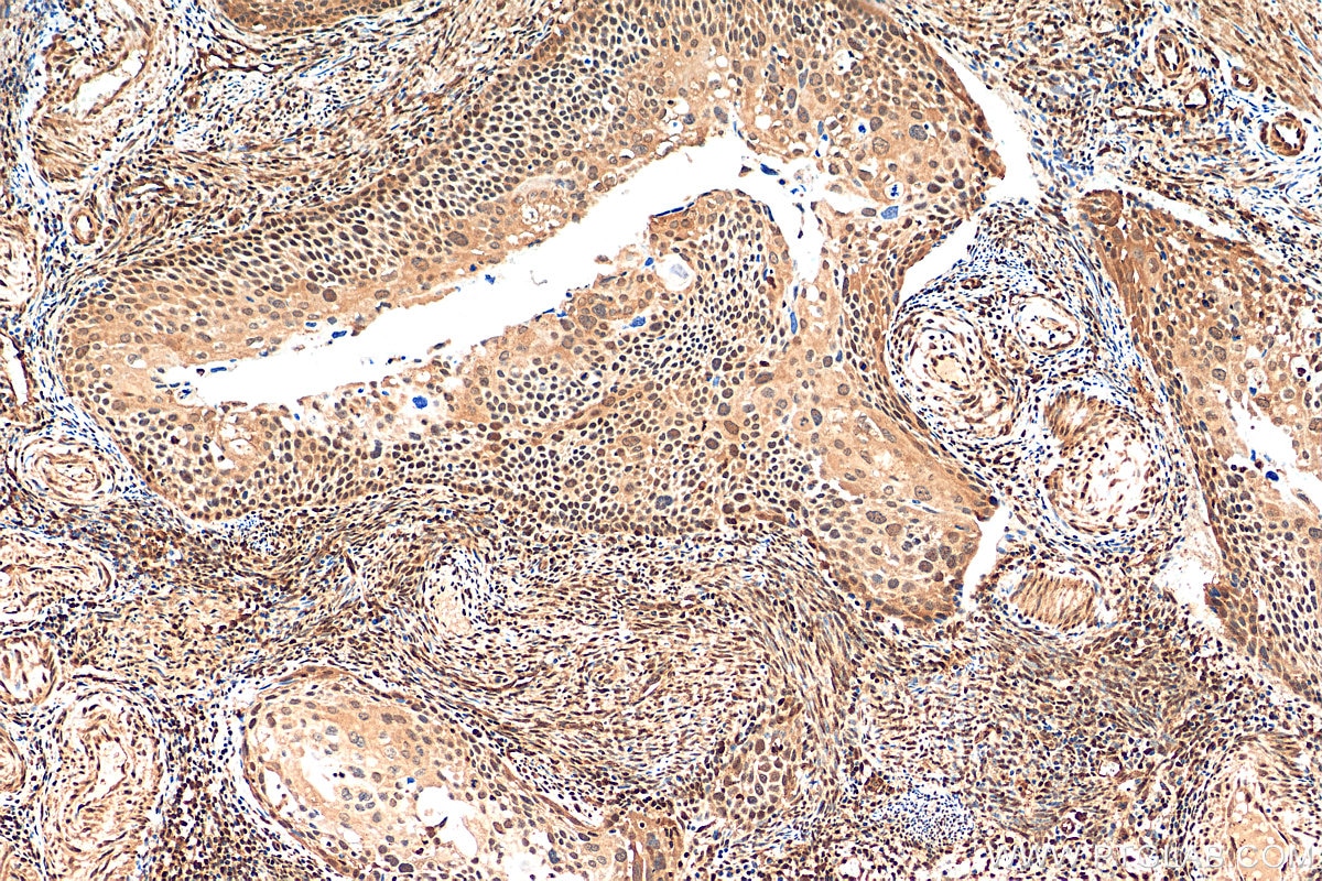 Immunohistochemistry (IHC) staining of human cervical cancer tissue using STAT5A/B Polyclonal antibody (13179-1-AP)