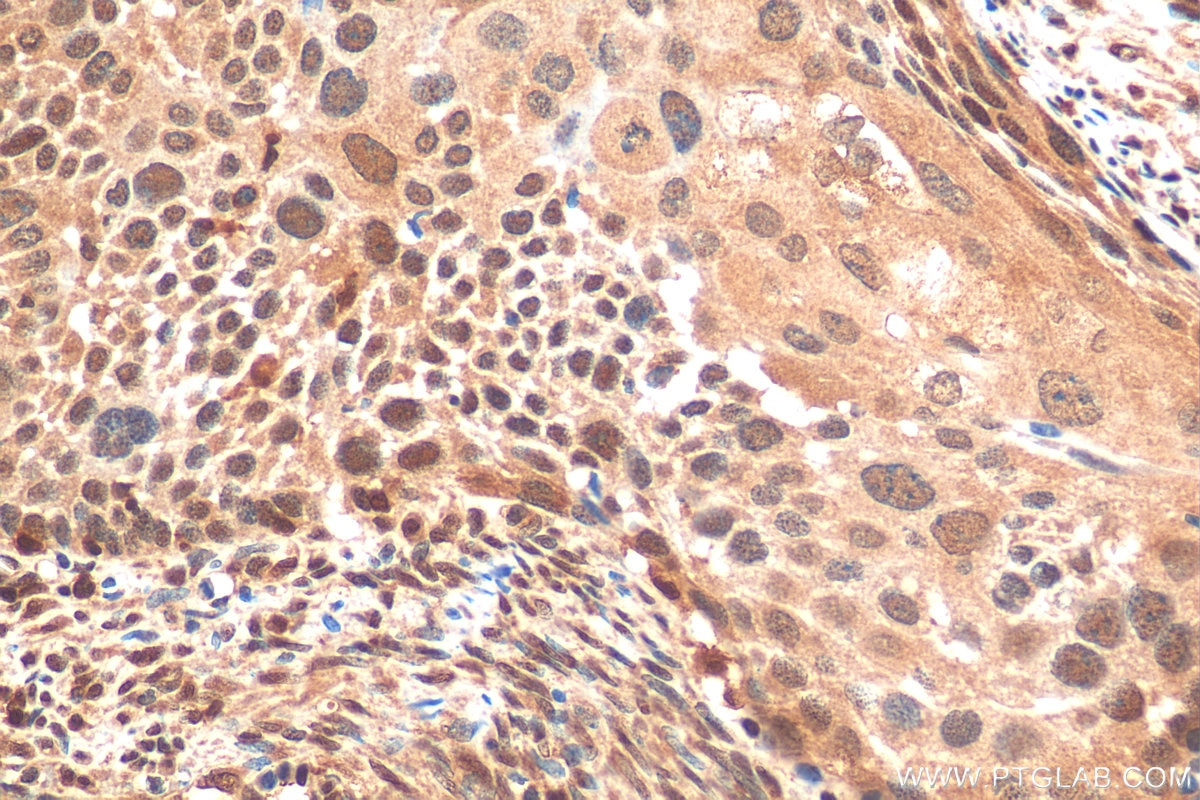 Immunohistochemistry (IHC) staining of human cervical cancer tissue using STAT5A/B Polyclonal antibody (13179-1-AP)