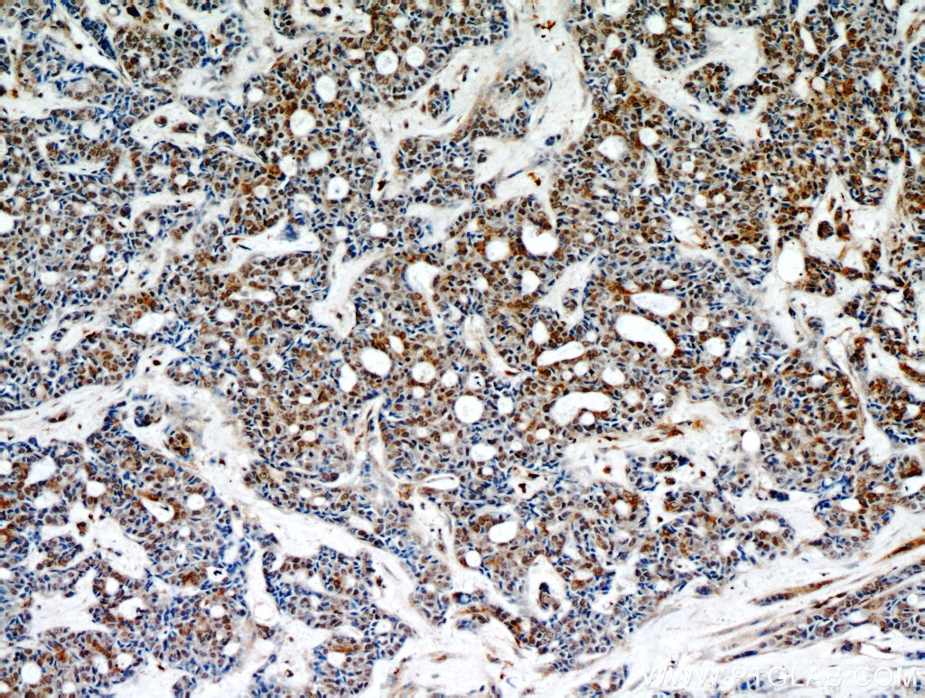 Immunohistochemistry (IHC) staining of human cervical cancer tissue using STAT5A/B Polyclonal antibody (13179-1-AP)