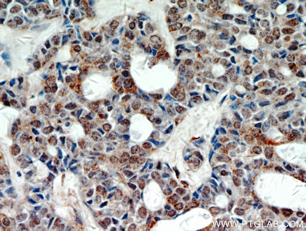 Immunohistochemistry (IHC) staining of human cervical cancer tissue using STAT5A/B Polyclonal antibody (13179-1-AP)