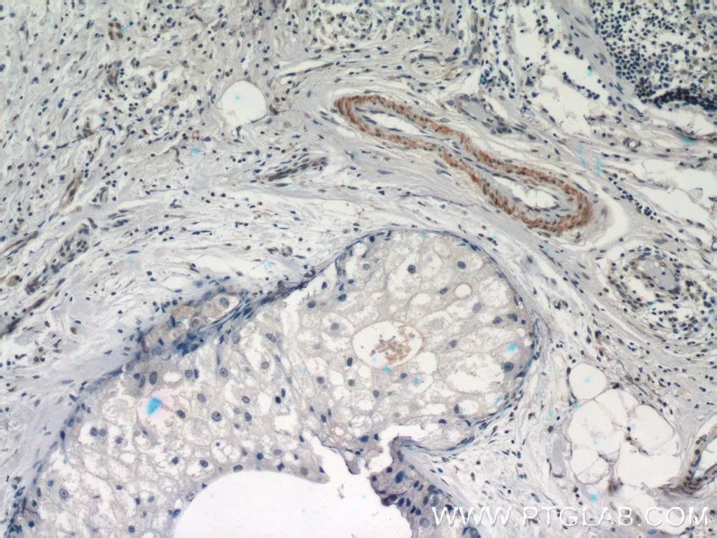 Immunohistochemistry (IHC) staining of human breast cancer tissue using STAT5A-Specific Polyclonal antibody (51074-2-AP)