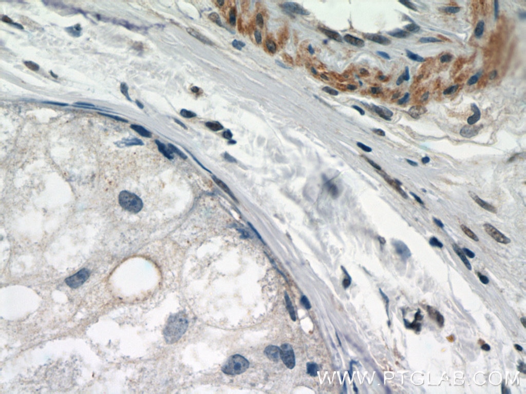Immunohistochemistry (IHC) staining of human breast cancer tissue using STAT5A Polyclonal antibody (51074-2-AP)