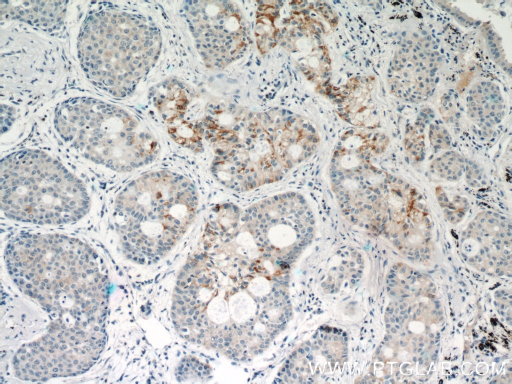 IHC staining of human lung cancer using 51074-2-AP