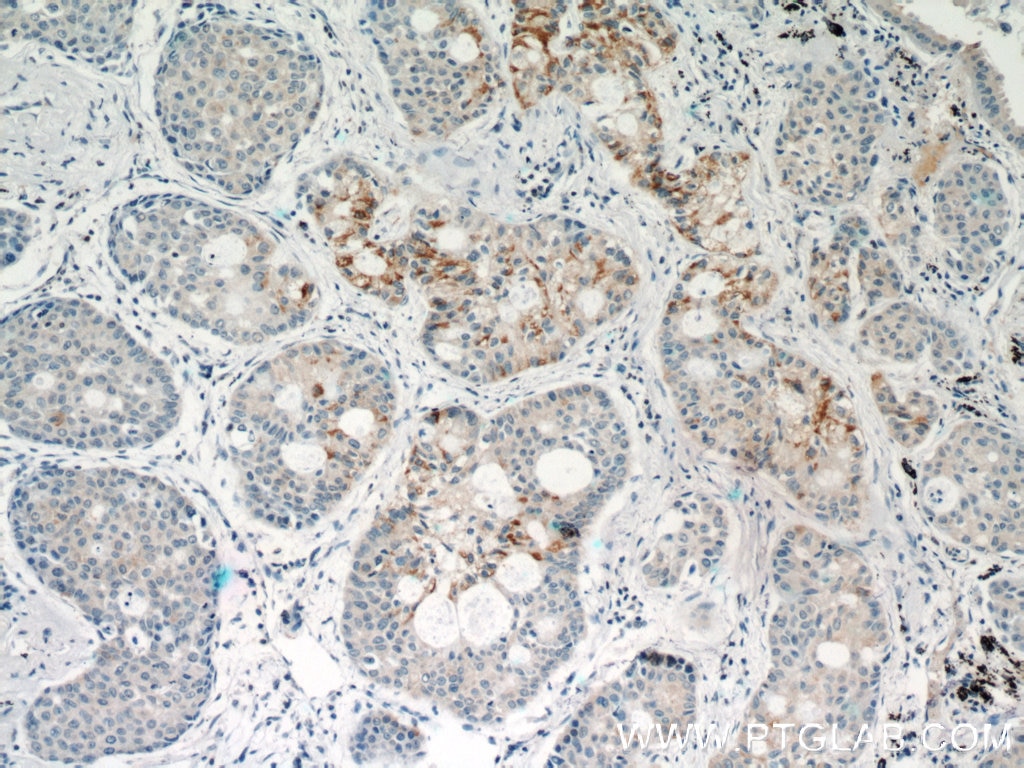 Immunohistochemistry (IHC) staining of human lung cancer tissue using STAT5A-Specific Polyclonal antibody (51074-2-AP)