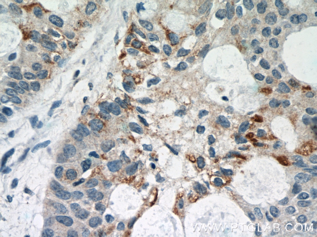 Immunohistochemistry (IHC) staining of human lung cancer tissue using STAT5A-Specific Polyclonal antibody (51074-2-AP)