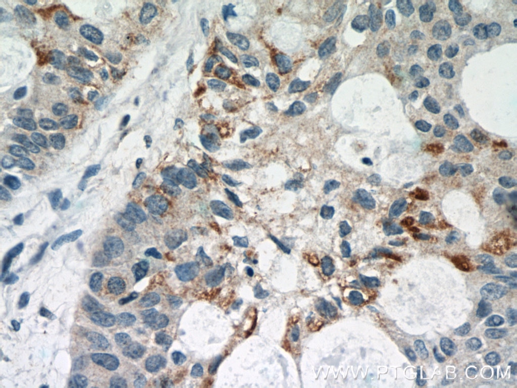 IHC staining of human lung cancer using 51074-2-AP