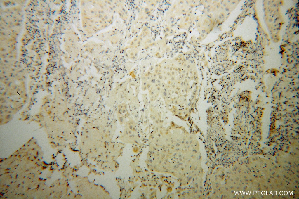 Immunohistochemistry (IHC) staining of human cervical cancer tissue using STAT5A-Specific Polyclonal antibody (51074-2-AP)